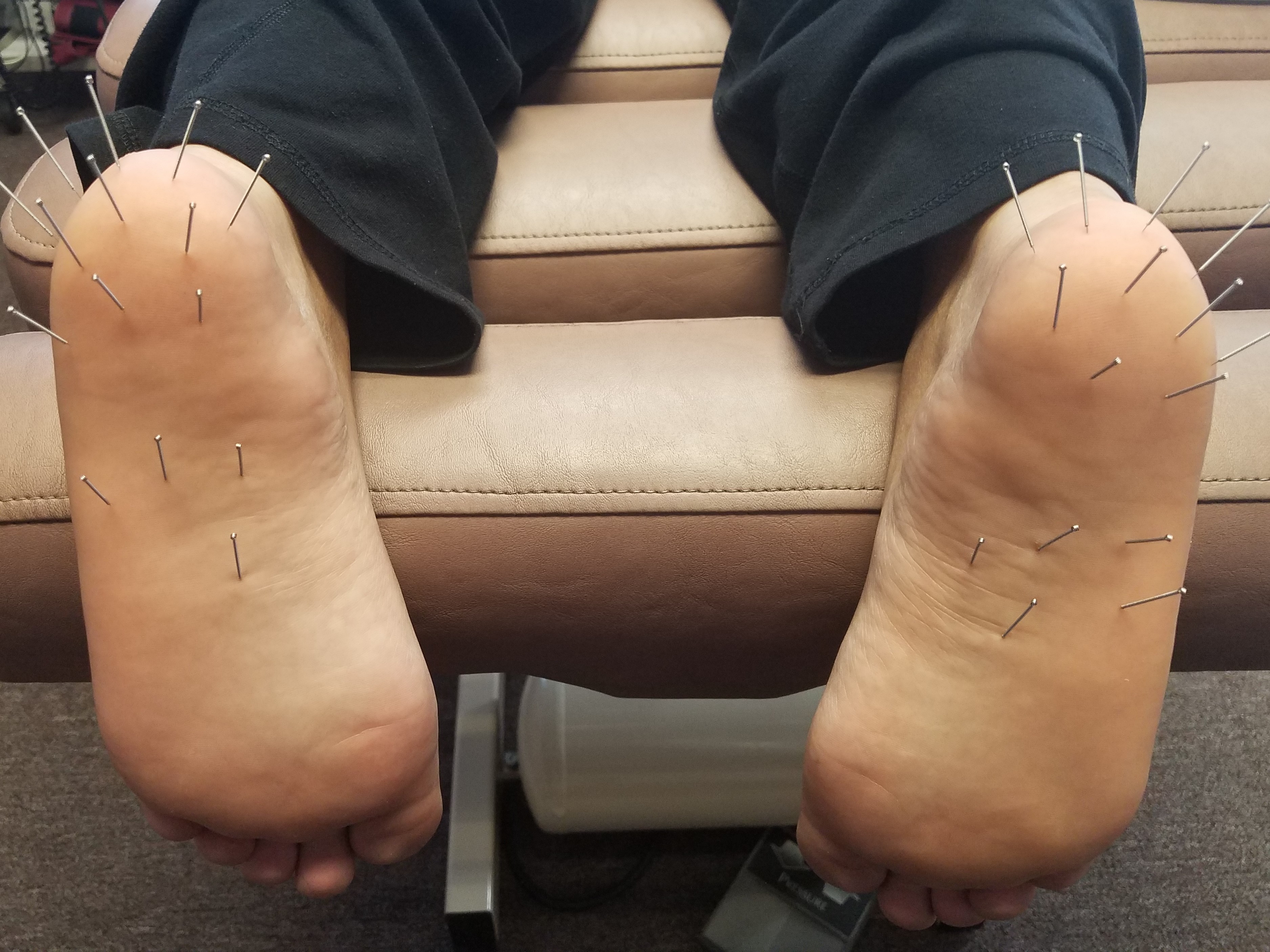 Dry needling align spine health center llc